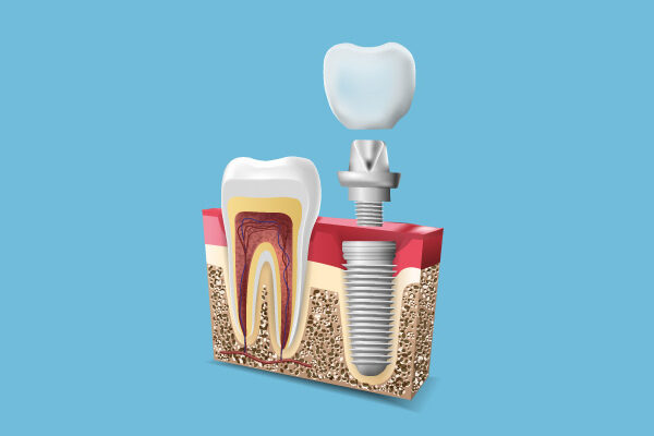 sonrident-Implante-Dental_portada