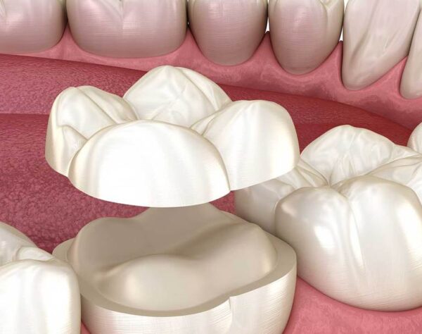 CoronaDental_Sonrident_2