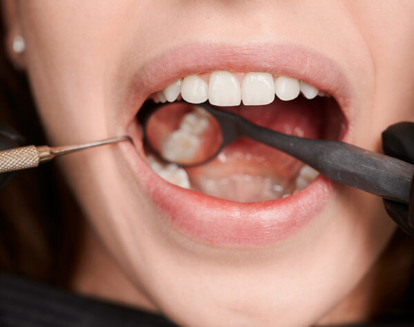 ResinasDentales_Sonrident_1